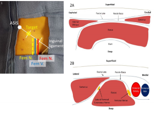Figure 1. The inguinal ligament may be divided into thirds, with the target site for injection being the lateral one-third mark. This lies lateral to the femoral nerve and vasculature. Figure 2. A: In the infrainguinal approach, the fascia lata and fascia iliaca form a “bow tie” when overlapping between the sartorius caudad and internal oblique cephalad, with underlying iliacus muscle spanning over the ilium. B: In the suprainguinal approach, the sartorius overlies the iliacus muscle on its lateral border, with the fascia iliaca separating the two muscles. The femoral nerve and vascular bundle lie medial to the iliacus muscle, and the lateral femoral cutaneous nerve lies between the muscle bodies.