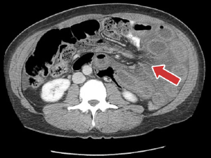 LEFT, Figure 1: The BEAM-ED tool. ABOVE, Figure 2: Internal hernia with small bowel obstruction.