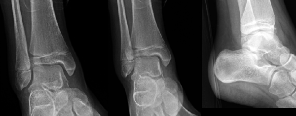 fractured ankle x ray