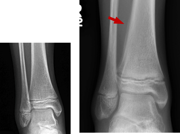 BELOW: Day 1 – normal RIGHT: Week 3 – subtle periosteal reaction lateral aspect distal tibia