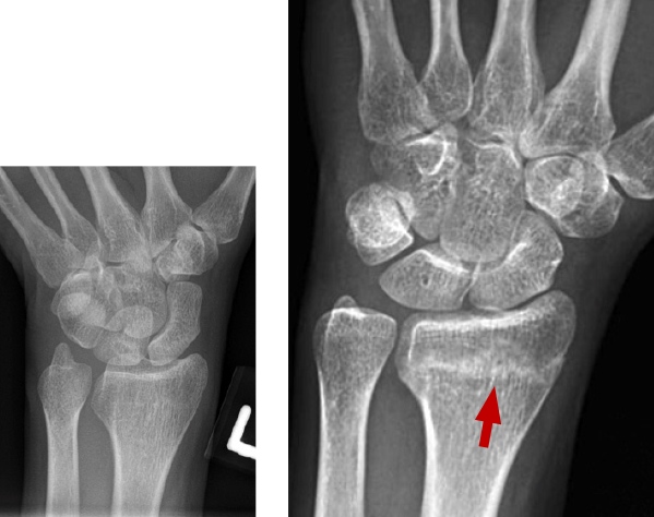 BELOW: Day 1 – normal RIGHT: Week 4 – sclerosis across distal radius