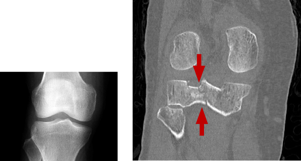 BELOW: Day 1 – no definite fracture RIGHT: Day 5 – CT: mildly depressed lateral tibial plateau