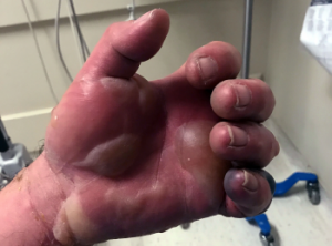 Figure 2: Rash and blisters on the patient’s left hand.