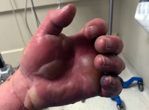 necrotizing fasciitis hand