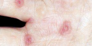 In Pediatric Erythema Multiforme Minor, Is Herpes a Common Cause?