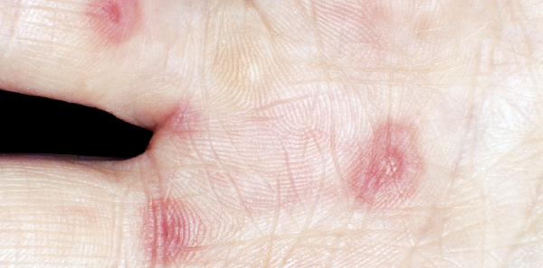 In Pediatric Erythema Multiforme Minor Is Herpes A Common Cause