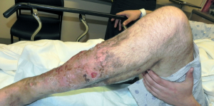 Case Report: Man Presents with Foul-Smelling Leg Wound