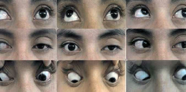 An example of a neuro-ophthalmologic examination in a patient with Tolosa-Hunt syndrome, prior to treatment. Note the left palpebral ptosis, exotropia of the primary look of the left eye, and paresis of the third, fourth, and sixth left cranial nerves.