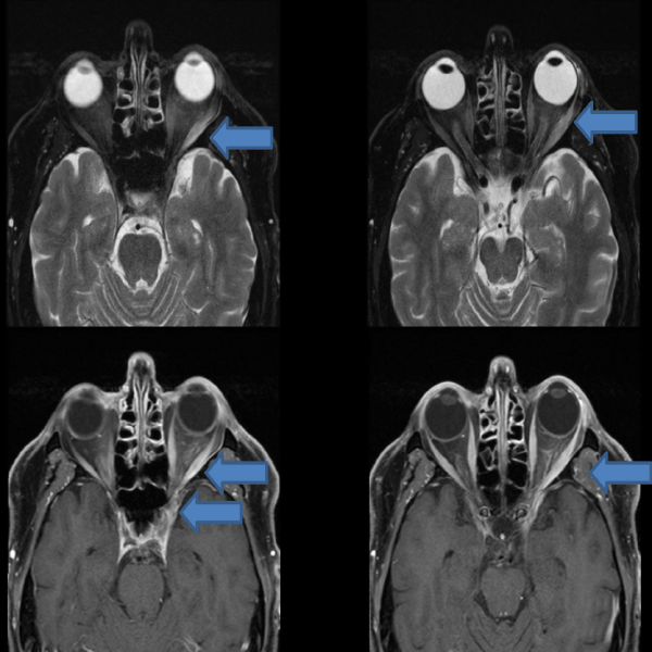 The patient’s MRI revealed an increased T2 signal with abnormal enhancement within the left lateral rectus muscle and intraconal fat extending into the orbital apex and left cavernous sinus.