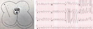 Atrial Fibrillation with RVR in a Patient with WPW