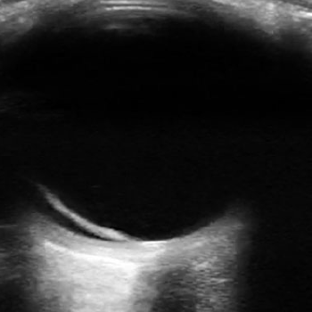 Figure 1: The optic nerve appears posteriorly as a hypoechoic structure and is measured 3 mm posterior to the globe.