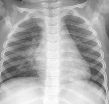 pneumonia pediatric chest ray old year infiltrate corticosteroids