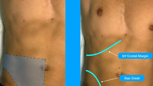 Figure 1A: The lateral ultrasound-guided TAP block will provide innervation to the anterior cutaneous branches of T10 to T12 (approximately the space highlighted). Figure 1B: Surface landmarks that should be palpated (if possible) include the inferior costal margin and the iliac crest. Place the ultrasound transducer between these two landmarks.