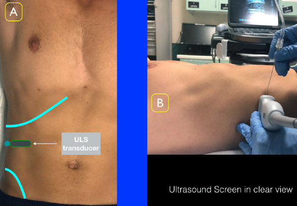 Figure 2A: Place the ultrasound transducer between the inferior costal margin and iliac crest. The probe marker should point lateral/posterior. Figure 2B: Position the ultrasound screen to ensure clear view of the location of injection as well as the ultrasound screen. 