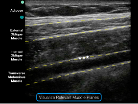 Figure 3: Note the external oblique, internal oblique, and transverse abdominis muscles on the ultrasound screen. The goal is to deposit anesthetic in the potential space just above the transverse abdominis muscle and just below the internal oblique muscle. 