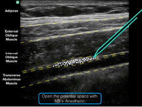 Figure 5: An ultrasound representation demonstrating where anesthetic should be placed when performing a TAP block.