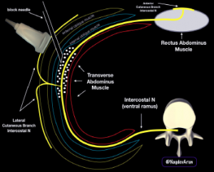 Figure 4: A schematic drawing of the ultrasound-guided TAP block. Note that anesthetic fluid should track in the plane between the internal oblique and transverse abdominis muscles. 