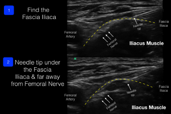 Figure 3: The block needle enters from lateral to medial and deposits anesthetic under the fascia iliaca (away from the femoral nerve and artery).