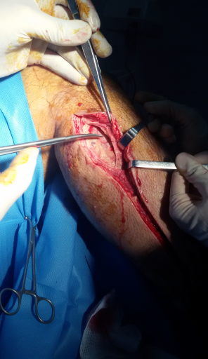 Figure 3: Lower leg fasciotomy