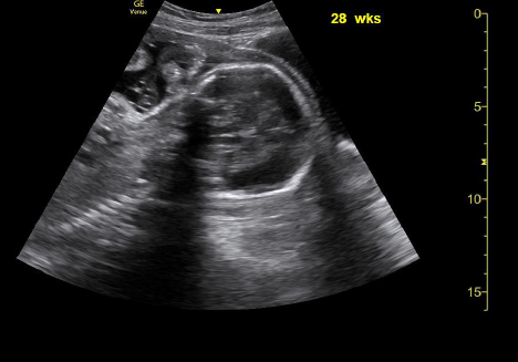 Sagittal and transverse