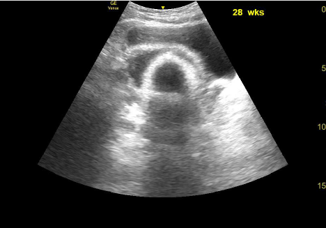 pelvic ultrasound of a female who is 28 weeks pregnant.