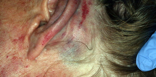 Bruising on the side of the patient’s head