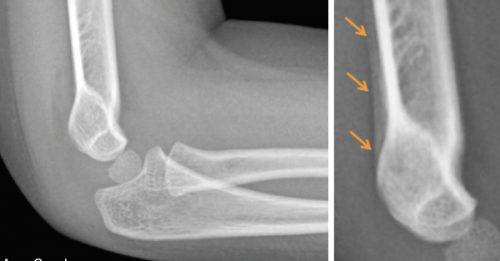 A 3-year-old girl fell while running. An X-ray the day of the fall (LEFT) showed no fracture, but her arm was splinted for possible occult fracture. A follow-up X-ray at three weeks (RIGHT) confirmed the fracture (arrows).