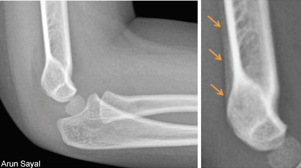 Una niña de 3 años se cayó mientras corría. Una radiografía el día de la caída (IZQUIERDA) no mostró ninguna fractura, pero su brazo fue entablillado por posible fractura oculta. Una radiografía de seguimiento a las tres semanas (DERECHA) confirmó la fractura (flechas).