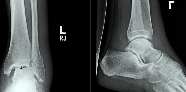 Figure 2: Normal ankle mortise view with demonstrated medial clear space (MCS) and superior clear space (SCS).