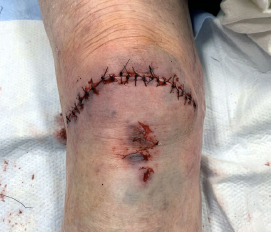 Figure 2: The patient’s knee following wound irrigation and repair.