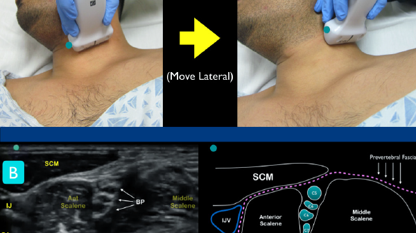 Figure 1 Figure 1A: Classic technique for locating the interscalene brachial plexus. At the level of the larynx, slide lateral until the ultrasound landmarks are noted Figure 1B: Just under the sternocleidomastoid muscle (SCM), locate the anterior and middle scalene muscles. The interscalene groove will contain the nerve roots of the brachial plexus. Note the internal jugular vein (IJV) and carotid artery (CA) on the medial aspect of the anterior scalene muscle.