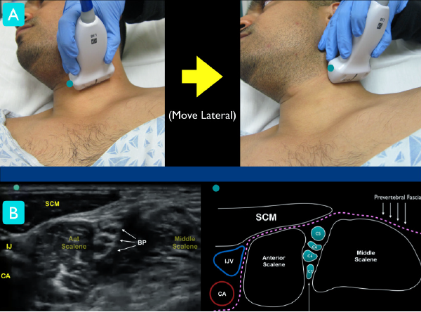 Figure 1 Figure 1A: Classic technique for locating the interscalene brachial plexus. At the level of the larynx, slide lateral until the ultrasound landmarks are noted Figure 1B: Just under the sternocleidomastoid muscle (SCM), locate the anterior and middle scalene muscles. The interscalene groove will contain the nerve roots of the brachial plexus. Note the internal jugular vein (IJV) and carotid artery (CA) on the medial aspect of the anterior scalene muscle.