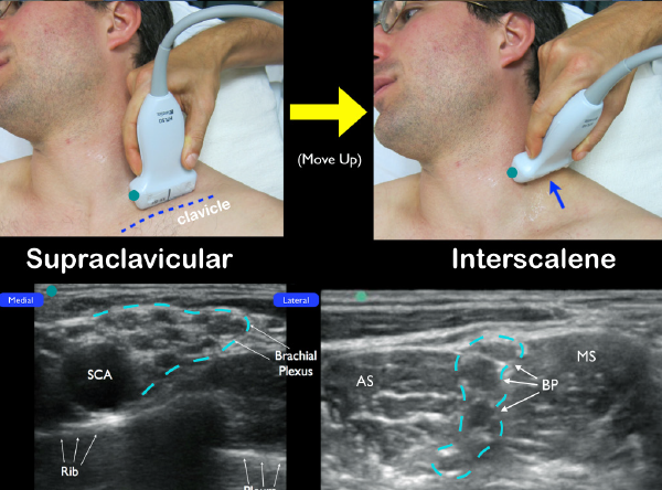 Figure 2 An alternative technique to locate the interscalane brachial plexus. Start with the transducer in the supraclavicular fossa. Locate the subclavian artery (SCA) in cross-section and note the brachial plexus just lateral (dotted blue line). Slide up the neck until the interscalene brachial plexus (BP) is located in between the anterior scalene (AS) and middle scalene (MS) muscles.