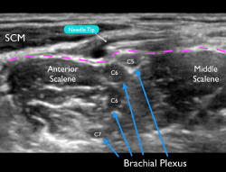 Figure 4 Ultrasound image of a failed block. Note that the needle tip is above the prevertebral fascia (pink dotted line). A small amount of anechoic anesthetic can be noted deposited above this important sonographic landmark.