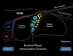 Figure 5 Schematic of how the needle tip should be placed just under the prevertebral fascia (and away from the roots of the brachial plexus). 