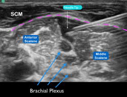 Figure 6 Ultrasound image of the needle tip under the prevertebral fascia (pink dotted line) with anechoic anesthetic deposited near the interscalene brachial plexus. 