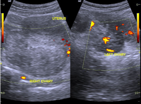 Figure 1 (ABOVE) Ovarian torsion on ultrasound with enlarged ovary and absent vascular flow.
