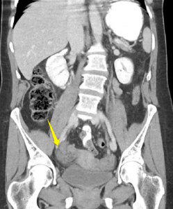Figure 2 (RIGHT) CT depicting twisted follicle and enlarged ovary.