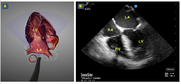 Transesophageal Echocardiography TEE Leesburg