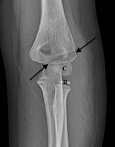 Figure 3B: AP view with markings. An oblique lucency above the capitellum and a minimal step-off laterally (arrows). C: capitellum. R: radial head