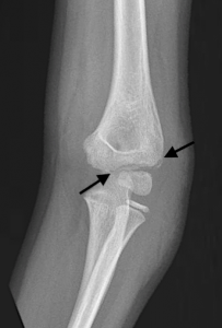 Figure 5B: AP view with markings. This shows two very subtle lucencies (arrows) seen superior and superolateral to the capitellum, consistent with a lateral condyle fracture.