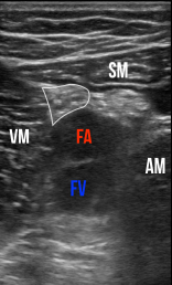 Figure 2: Transverse sonographic view of the adductor canal. The sartorius muscle (SM) forms the “roof.” Vastus medialis (VM) is medial, and the adductor magnus (AM) is lateral. The saphenous nerve (white outline) lies between the femoral artery (FA) and the sartorius. FV is the femoral vein.