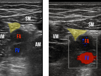 Figure 3: Sonographic view of the adductor canal. The saphenous nerve is highlighted.