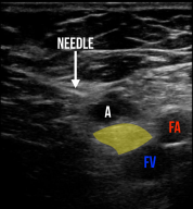 Figure 5: The hyperechoic needle is positioned correctly as the operator administers local anesthetic (A) just above the saphenous nerve (yellow). This in-plane approach provides better visualization of the needle during the procedure.