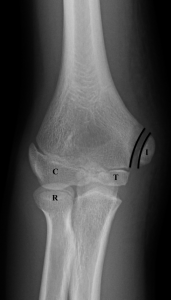 Figure 6A: AP view with markings. This identifies the ossification centers of the capitellum (C), radial head (R), internal (medial) epicondyle (I), and trochlea (T). Two black lines show a medial condyle physis slightly wider than the other growth plates on the image.