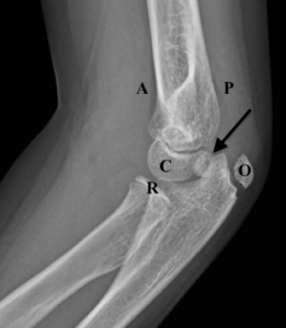 Figure 9B: Lateral view with markings. Ossification centers of capitellum (C), radial head (R), and olecranon (O), are seen. The internal (medial) epicondyle is identified by the arrow, avulsed into the joint. There is also, again slightly rotated, a small anterior fat pad seen (A) (not a “sail,” so this is normal) and very small posterior fat pad (P) (always abnormal). 