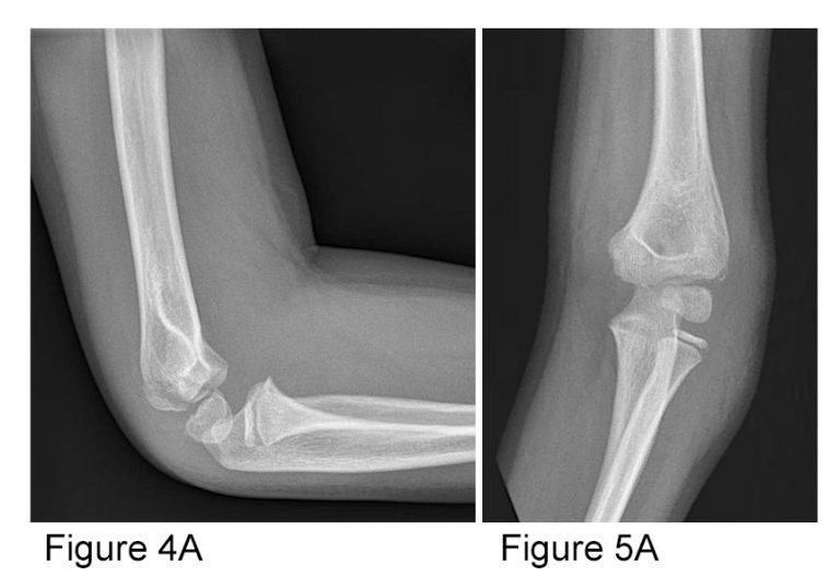 How to Avoid Missing a Pediatric Elbow Fracture ACEP Now
