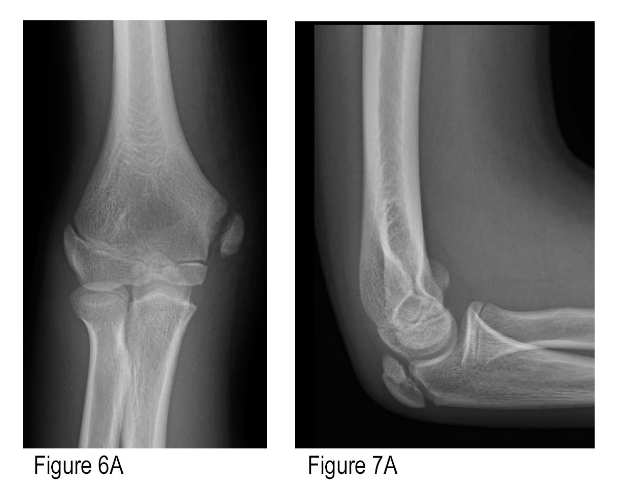 How to Avoid Missing a Pediatric Elbow Fracture - ACEP Now