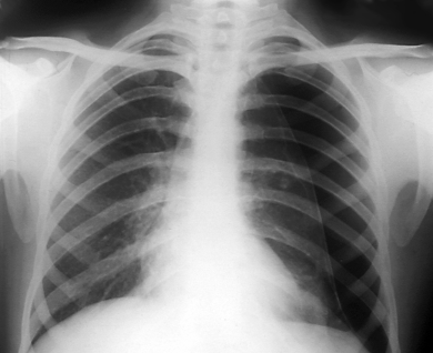 Frontal chest X-ray of a patient with a pneumothorax.