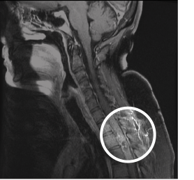 Figure 1: Cervical MRI showing expansion of the cervical cord, originating at the C5 level and extending into the lower thoracic spine. The most prominent areas of hemorrhage are in the T2– T3 levels, with multiple serpentine structures.